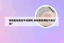 体检能检查出牛皮癣吗 体检银屑病能不能过关?