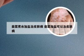 韭菜煮水加盐治皮肤病 韭菜加盐可以治皮肤病