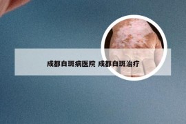 成都白斑病医院 成都白斑治疗