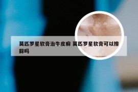 莫匹罗星软膏治牛皮癣 莫匹罗星软膏可以擦藓吗