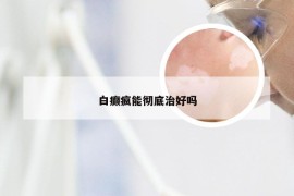 白癫疯能彻底治好吗