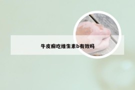 牛皮癣吃维生素b有效吗