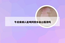 牛皮癣病人能喝阿胶补血口服液吗