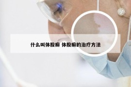 什么叫体股癣 体股癣的治疗方法