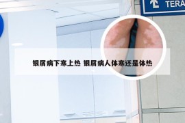 银屑病下寒上热 银屑病人体寒还是体热