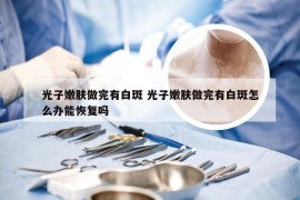 光子嫩肤做完有白斑 光子嫩肤做完有白斑怎么办能恢复吗