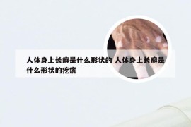 人体身上长癣是什么形状的 人体身上长癣是什么形状的疙瘩