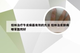 桂林治疗牛皮癣最有效的方法 桂林治皮肤病哪家医院好