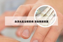 血清丸能治银屑病 清血银屑胶囊