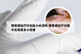 银屑病治疗时会起小水泡吗 银屑病治疗过程中出现很多小疙瘩