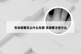 生皮癣要忌口什么东西 生癣要注意什么