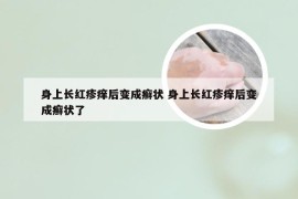 身上长红疹痒后变成癣状 身上长红疹痒后变成癣状了