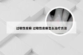 过敏性皮癣 过敏性皮癣怎么治疗方法