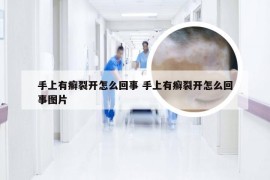 手上有癣裂开怎么回事 手上有癣裂开怎么回事图片