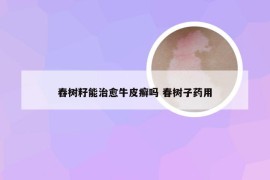 舂树籽能治愈牛皮癣吗 春树子药用