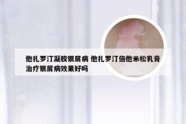 他扎罗汀凝胶银屑病 他扎罗汀倍他米松乳膏治疗银屑病效果好吗