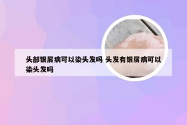 头部银屑病可以染头发吗 头发有银屑病可以染头发吗