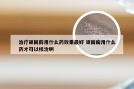 治疗顽固藓用什么药效果最好 顽固癣用什么药才可以根治啊