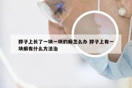 脖子上长了一块一块的癣怎么办 脖子上有一块癣有什么方法治