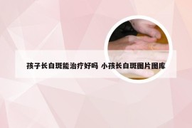 孩子长白斑能治疗好吗 小孩长白斑图片图库