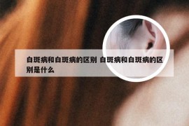 白斑病和白斑病的区别 白斑病和白斑病的区别是什么