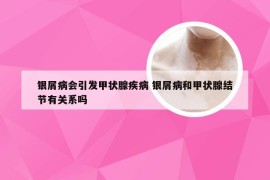 银屑病会引发甲状腺疾病 银屑病和甲状腺结节有关系吗