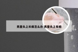 男童头上长癣怎么办 男童头上有癣