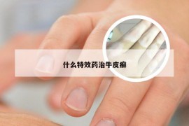 什么特效药治牛皮癣