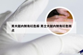 男大腿内侧有红色癣 男士大腿内侧有红色斑点