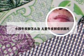 小孩牛皮鲜怎么治 儿童牛皮鲜症状图片