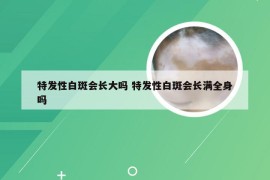 特发性白斑会长大吗 特发性白斑会长满全身吗