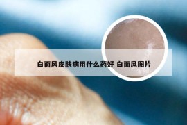 白面风皮肤病用什么药好 白面风图片