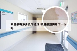 银屑病有多少几率遗传 银屑病遗传给下一代吗