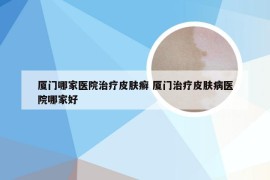 厦门哪家医院治疗皮肤癣 厦门治疗皮肤病医院哪家好