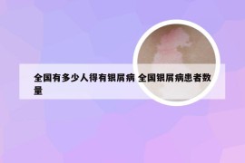 全国有多少人得有银屑病 全国银屑病患者数量