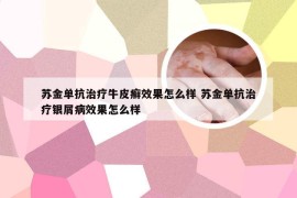 苏金单抗治疗牛皮癣效果怎么样 苏金单抗治疗银屑病效果怎么样