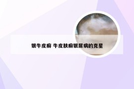 银牛皮癣 牛皮肤癣银屑病的克星