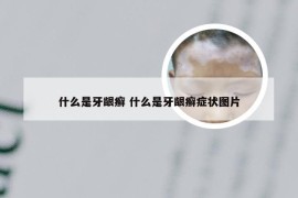 什么是牙龈癣 什么是牙龈癣症状图片