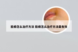 脸癣怎么治疗方法 脸癣怎么治疗方法最有效