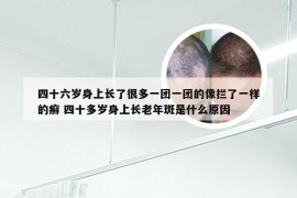 四十六岁身上长了很多一团一团的像拦了一样的癣 四十多岁身上长老年斑是什么原因