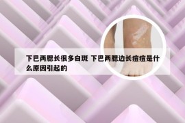 下巴两腮长很多白斑 下巴两腮边长痘痘是什么原因引起的