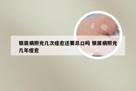 银屑病照光几次痊愈还要忌口吗 银屑病照光几年痊愈