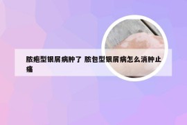 脓疱型银屑病肿了 脓包型银屑病怎么消肿止痛