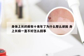 身体上长的癣有十来年了为什么那么顽固 身上长癣一直不好怎么回事