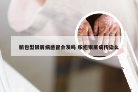 脓包型银屑病感冒会发吗 脓疱银屑病传染么