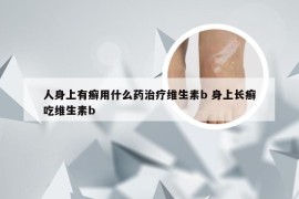 人身上有癣用什么药治疗维生素b 身上长癣吃维生素b