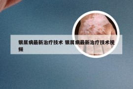 银屑病最新治疗技术 银屑病最新治疗技术视频