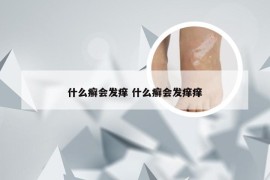 什么癣会发痒 什么癣会发痒痒