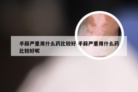 手藓严重用什么药比较好 手藓严重用什么药比较好呢