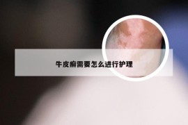 牛皮癣需要怎么进行护理